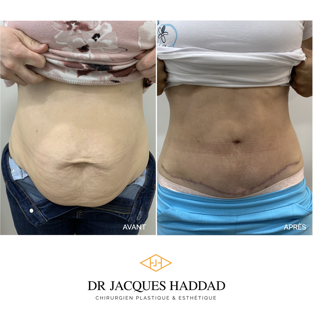 Abdominoplastie - chirurgie esthétique du ventre, liposuccion — Dr ...